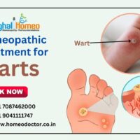 Get the Best Homeopathic Treatment for Warts in India?